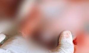 Salah seorang dokter yang sedang menangani masyarakat di Ngguti setelah menderita kusta – Surya Papua/IST