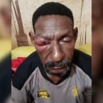 Korban Lamek Wayoken yang matanya bengkak diduga dianiaya dua oknum anggota Brimob – Surya Papua/IST