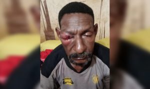 Korban Lamek Wayoken yang matanya bengkak diduga dianiaya dua oknum anggota Brimob – Surya Papua/IST