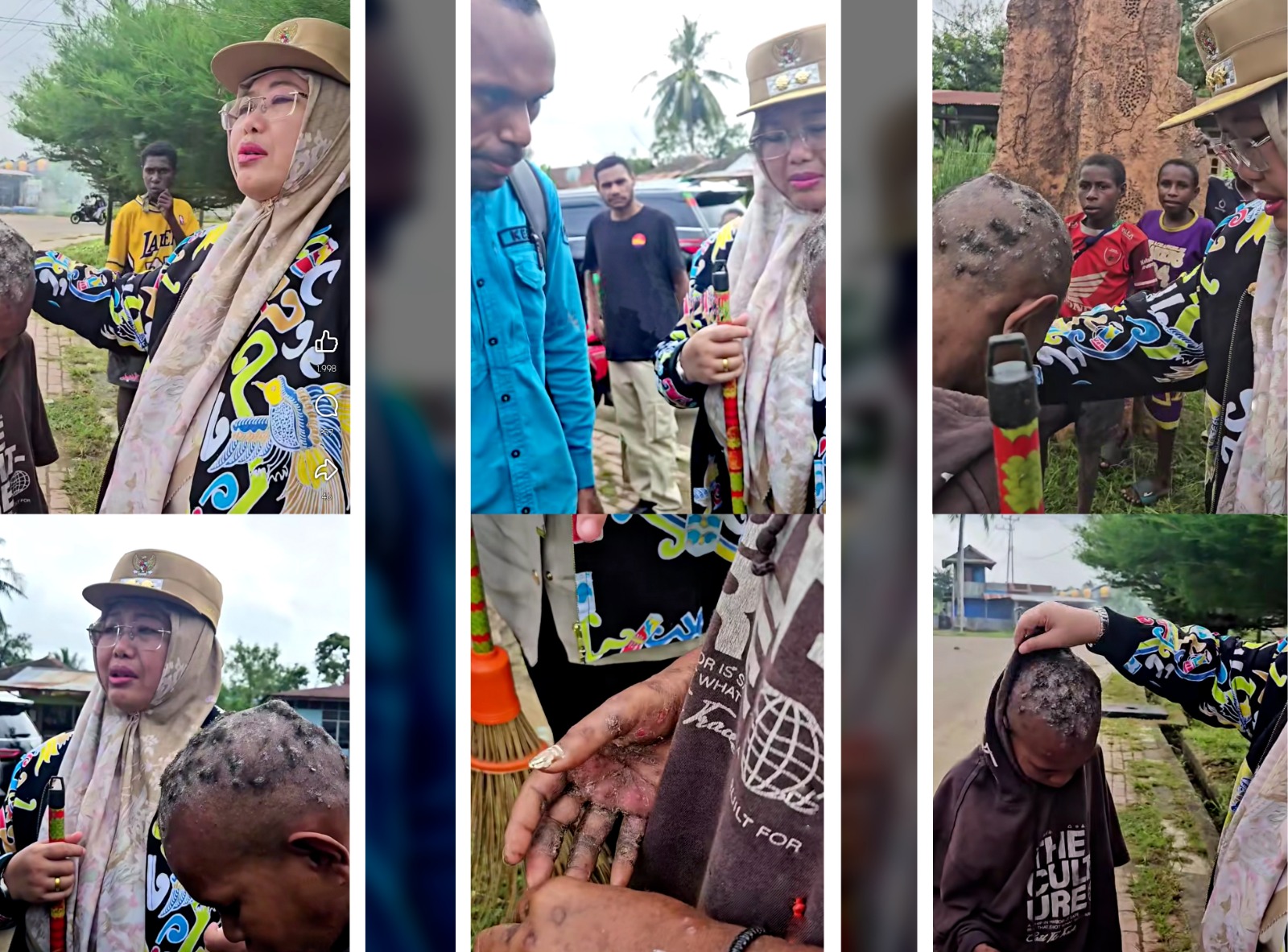 Wakil Bupati Merauke, Fauzun Nihayah sedang memeriksa luka di sekujur tubuh salah seorang anak Papua – Surya Papua/IST