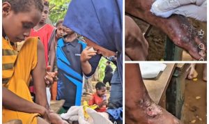 luka 6 Wakil Bupati Merauke, Fauzun Nihayah sedang membersihkan luka-luka seorang anak – Surya Papua/IST